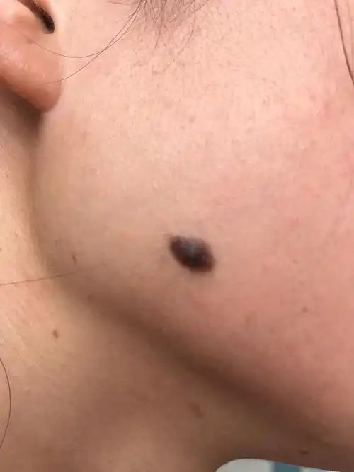 色素痣良性or恶性怎么去除