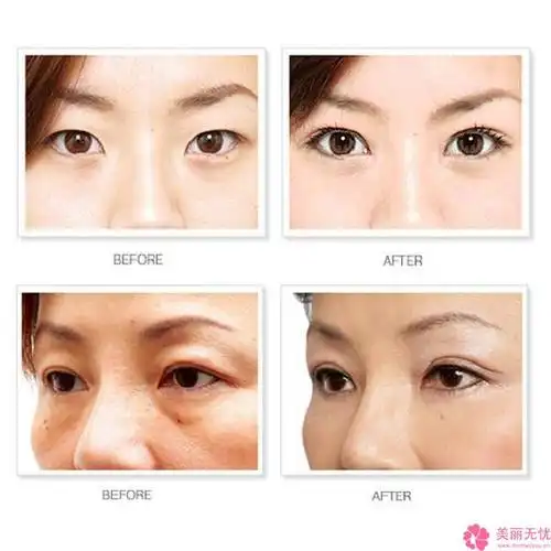 玉溪儿童上眼睑倒睫手术不当会造成哪些后果