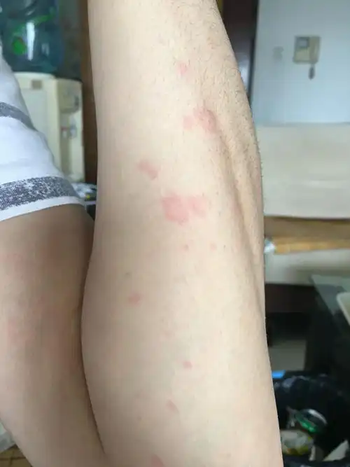 皮肤突然起了红点红包,比较痒,有认识的朋友说下是什么症状,有图