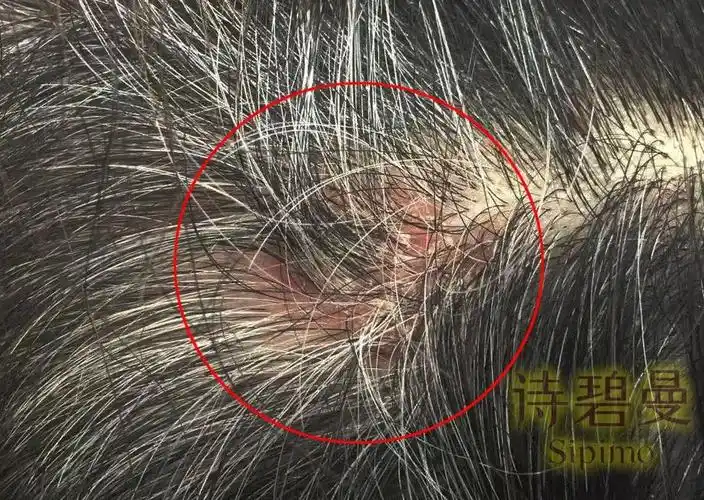 头皮毛囊炎症:头皮毛囊不健康,如:头屑多,头皮痒,头皮有痘痘,脂溢性