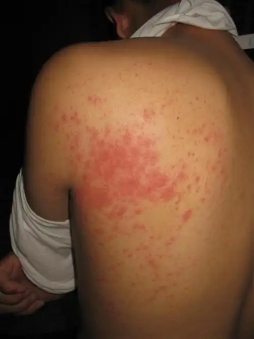 看图识病-------螨虫皮炎