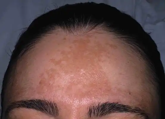 妊娠斑图片 (1)_有来医生