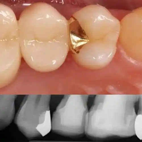 黄金嵌体补牙避免继发龋寿命35年以上金合金嵌体