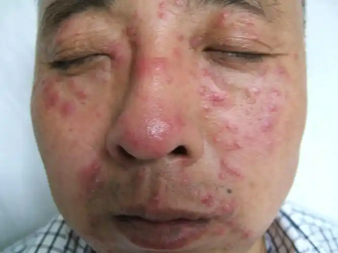 皮肤性病 -丁香园论坛