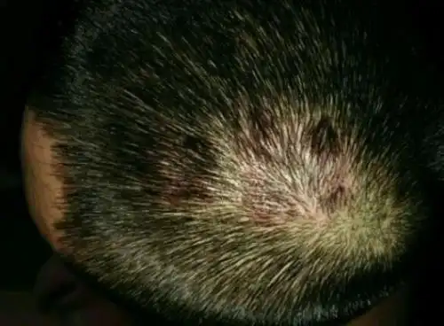 头癣 头癣是指毛发和头皮的皮肤癣菌感染.好发于儿童,成人很少感染.