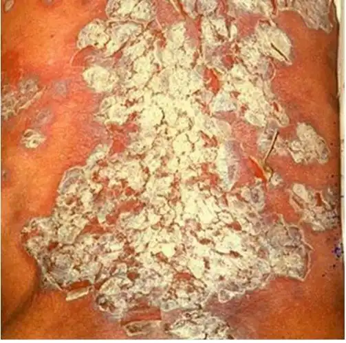 大疱性皮肤病图片