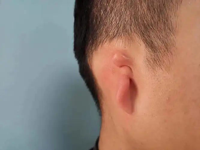 先天性小耳畸形的治疗主要包括两方面,一方面是耳廓再造,另一方面是听