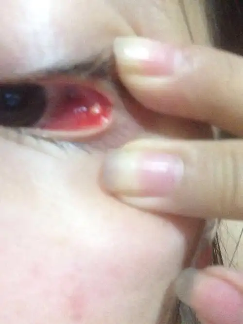 眼睛下眼皮长了个疙瘩这是什么情况有人知道吗