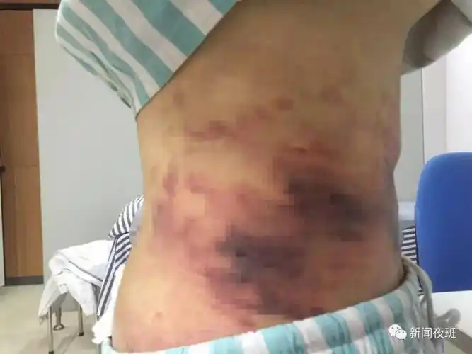 可怕!南宁一女孩做吸脂手术,腰部竟出现大片淤黑!医生:再不治疗就会.
