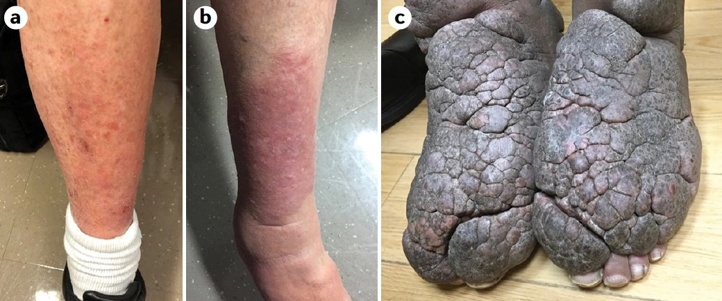 少见且容易遗漏,graves病的这种特征性皮肤病变你见过吗?