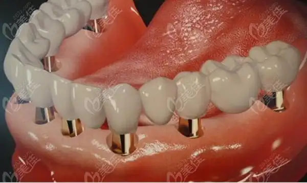 半口种植牙是连在一起好还是分开好若选后者种植后又该如何维护