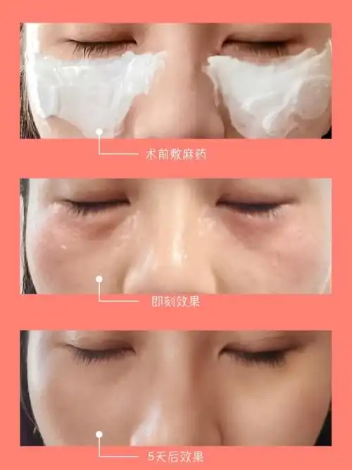 969696嗨体祛泪沟案例分享#填充泪沟# 年轻人吧,就_圈子-新氧