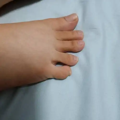 小脚趾这样有危害吗