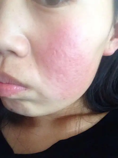 吃了一碗牛肉汤脸部过敏严重,怎么办