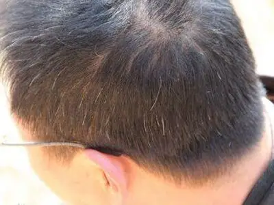 白发出现的原因究竟为何 你知道吗