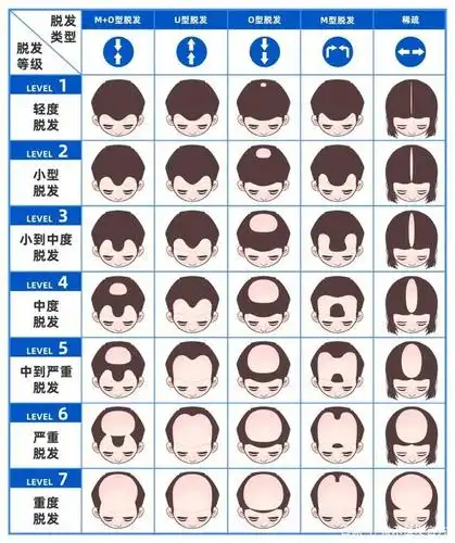 脱发必学鉴定技能 | 4招自测你到底秃没秃?
