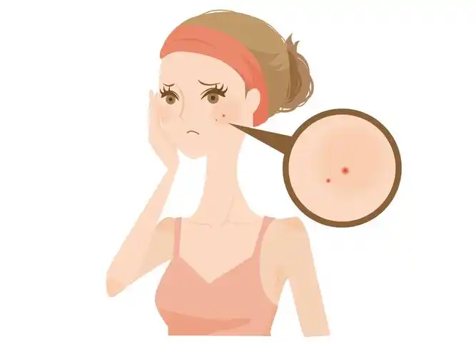 怎么才能让青春痘消失,如何护理痘肌