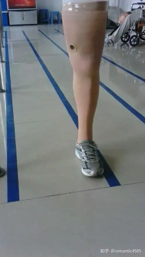 小孩小腿假肢包装人们是怎么弄的像真腿一样78岁小孩子内向不想让其他