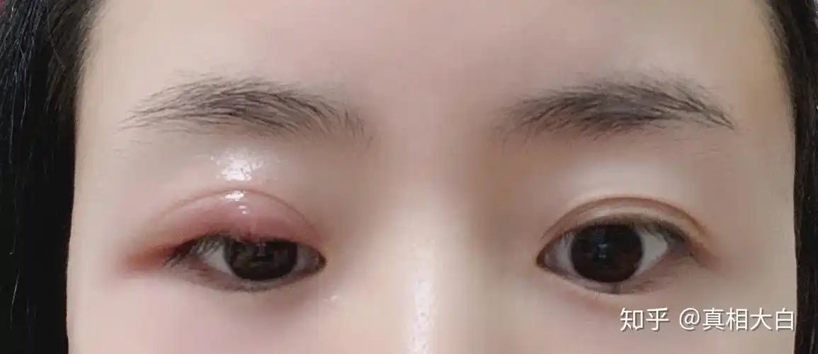 不开刀成功抗击麦粒肿内容不适慎入