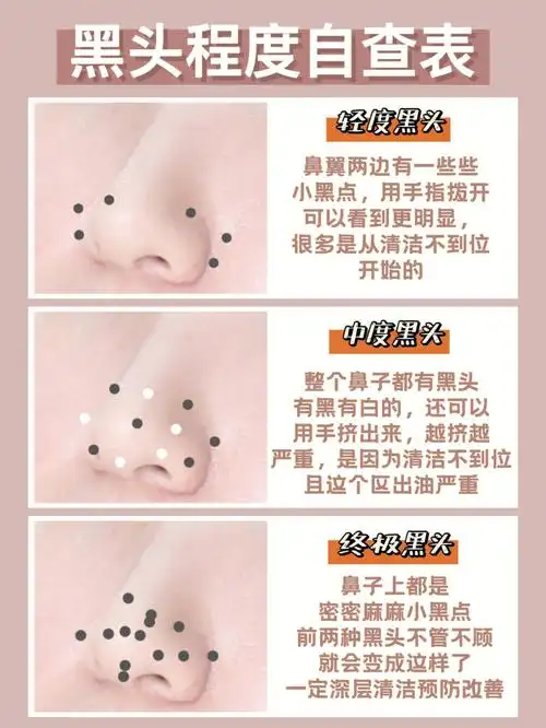 黑头毛孔污垢全掏空了066毛孔不是梦