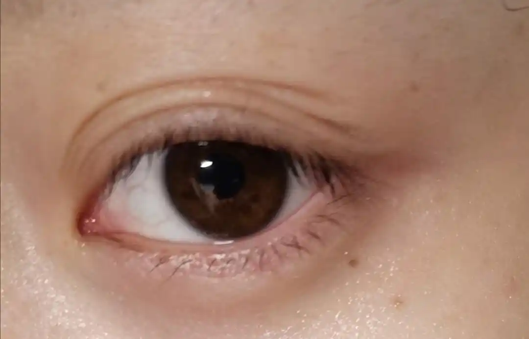 左眼突然多层眼皮怎么办啊啊啊都变大小眼了