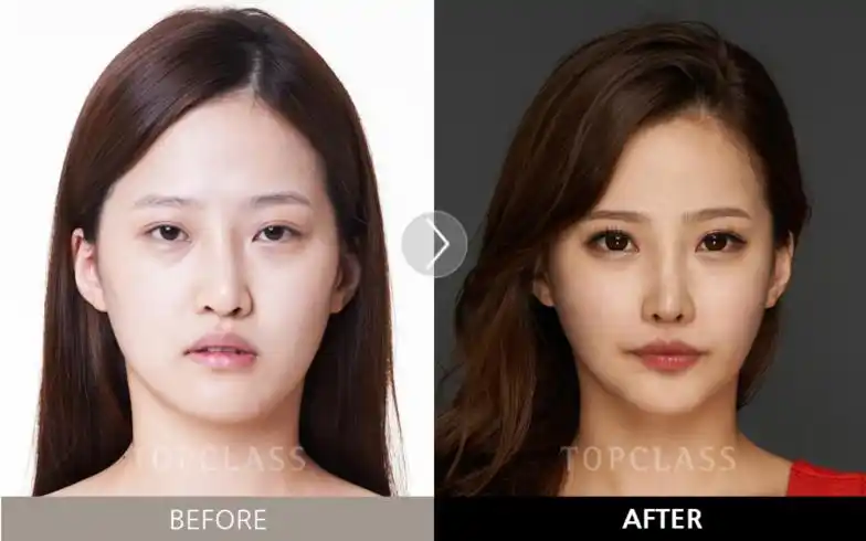 韩国topclass整形外科隆鼻前后对比案例