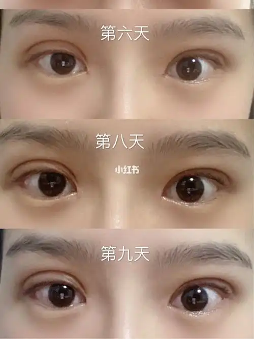 埋线双眼皮第九天