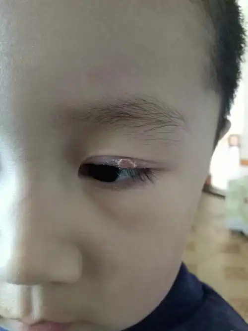 宝宝快五岁了,春节的时候眼皮上长了个包,刚开始没在意,后来长大了,去
