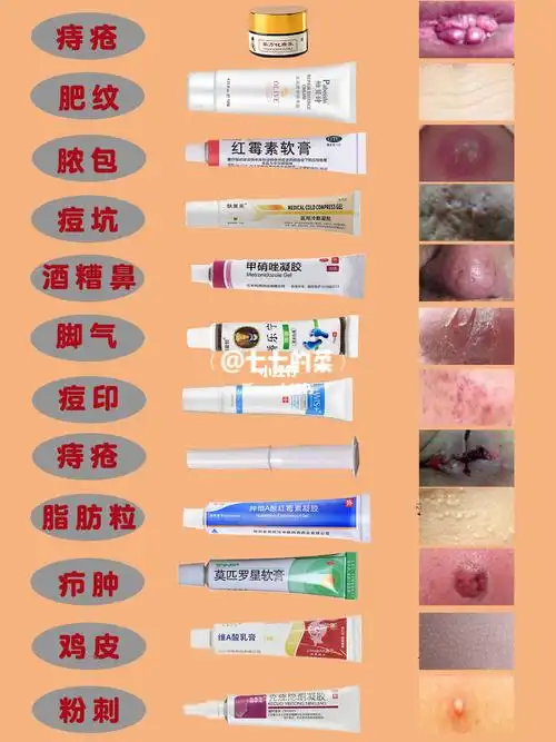 必备皮肤药膏合集,轻松解决各种小问题 甲硝唑凝胶用于炎症性丘疹