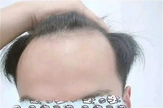 发际线高怎么办?