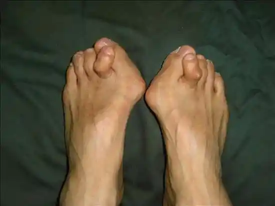 "削足适履"的医学道理 - 好大夫在线