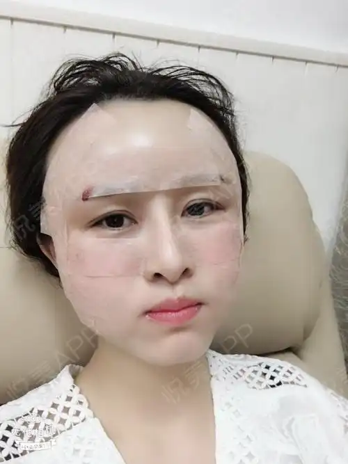 自体脂肪面部填充手术当天_面部填充手术当天_自体脂肪手术当天_面部