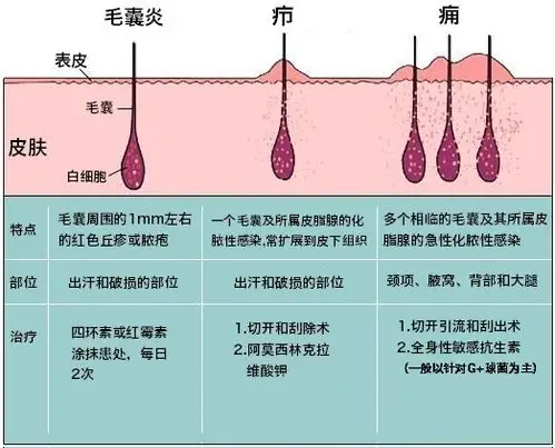 图解健康:毛囊炎,疖和痈的区别