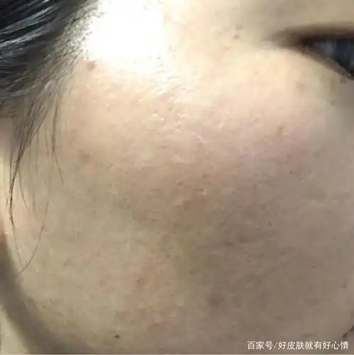 脸上的脸多,油性皮肤,大油田是如何形成的?如何调理改善?