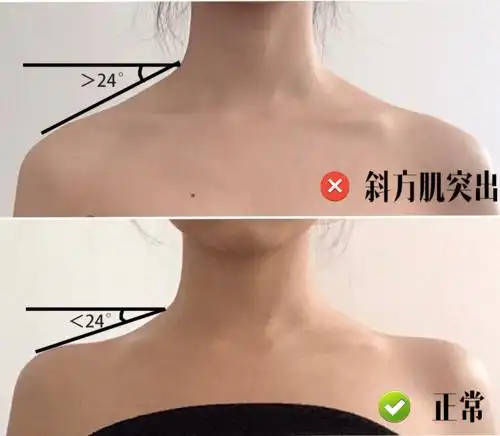 关于斜方肌发达发有个专业的说法:肩斜度(颈跟外侧点和肩峰点的连线