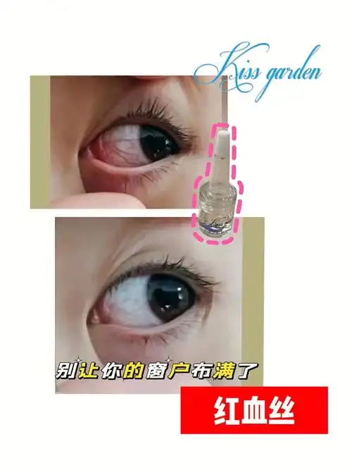 眼睛是心灵的窗户别让红血丝蒙上你的眼睛