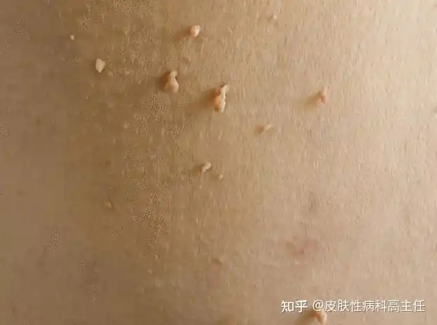 不要把丝状疣当做尖锐湿疣,给自己造成困扰. - 知乎