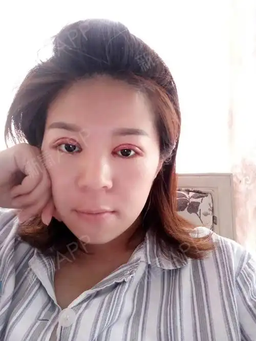 今天是我做双眼皮的第二天给你们看看照片