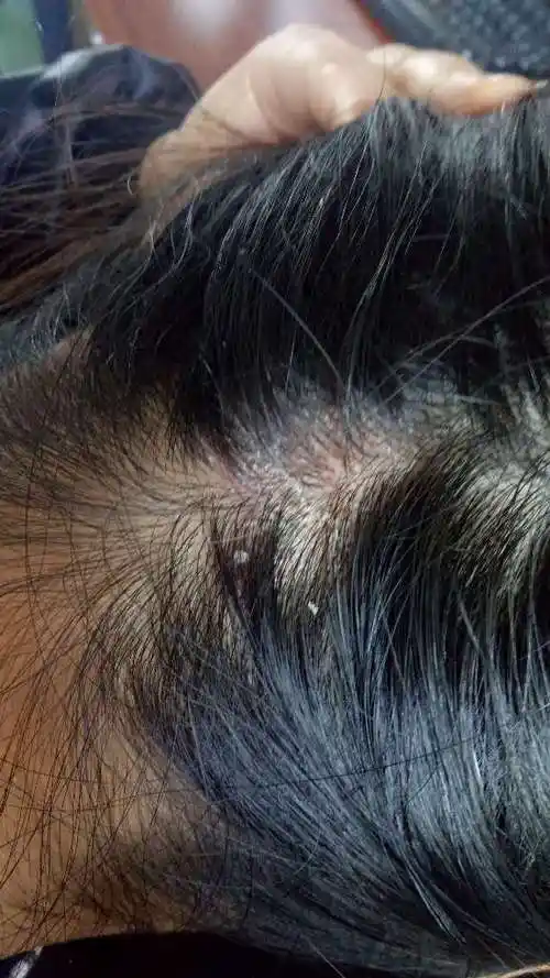 头部长了很多皮屑一样的东西请问是什么不痛不痒