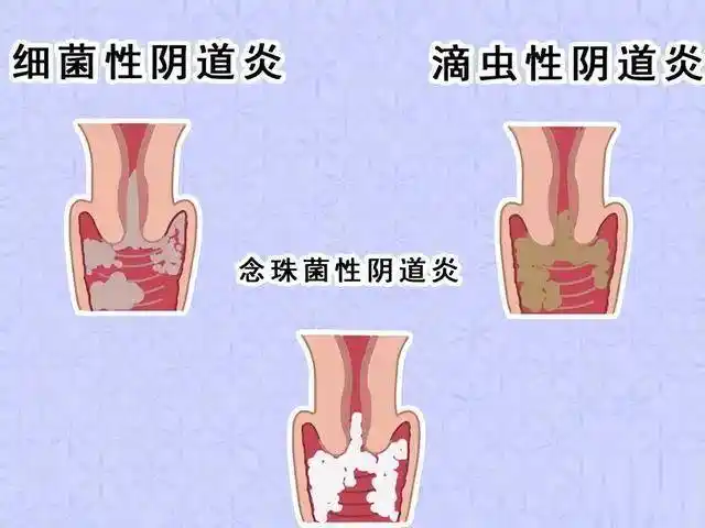 以细菌性阴道炎,外阴阴道念珠菌感染,滴虫性阴道炎为主,此病迁延反复