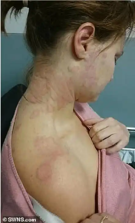 浑身荨麻疹因对压力极度过敏英国一打工人裸辞旅行后不药而愈