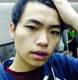 韩国丽偶医院男生鼻整形面部填充案例对比