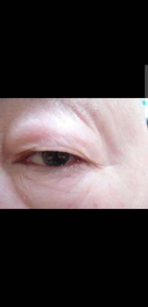 当心!一旦眼睛出现这七种症状,可能是大病征兆