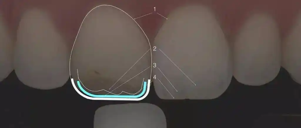 病例分享中切牙的修复复合树脂直接修复vs全瓷贴面修复