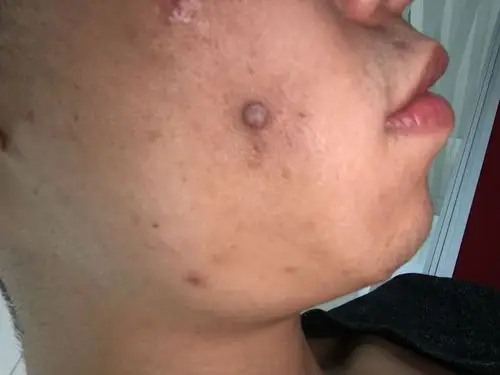 痘痘结痂后变成了一个小硬块