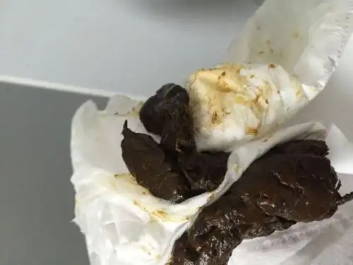 所谓的黑便是指粪便变得纯黑色的吗