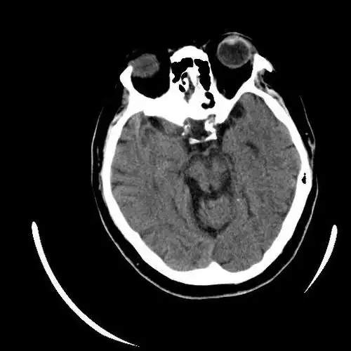 ▎头颅ct平扫有高血压病史10年,最高血压190/100mmhg,目前口服药物