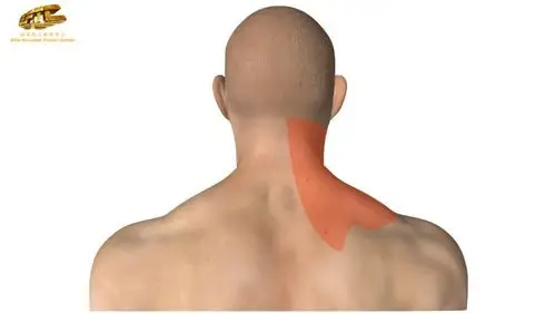 肩胛提肌损伤会导致颈椎僵硬和疼痛,并且这种疼痛会沿着肩胛