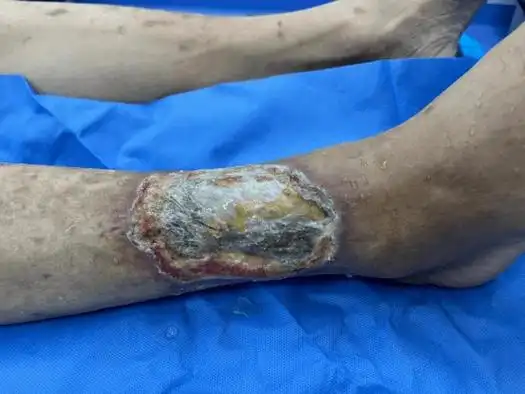 小伤口不注意,险些截肢!