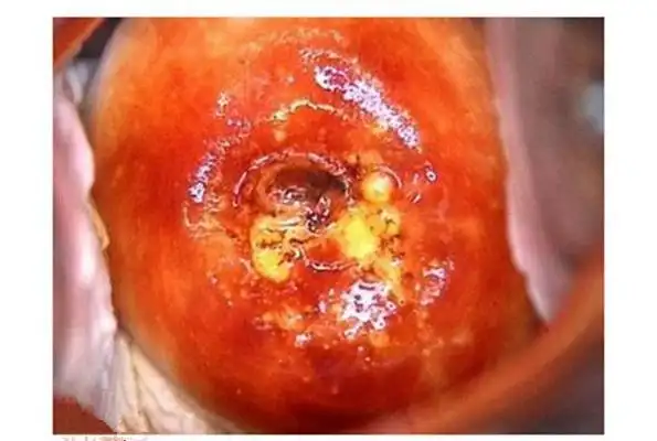 淋病的症状 (48)